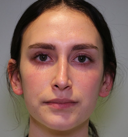 asymmetric nose after red Asymmetric nose rhinoplasty after