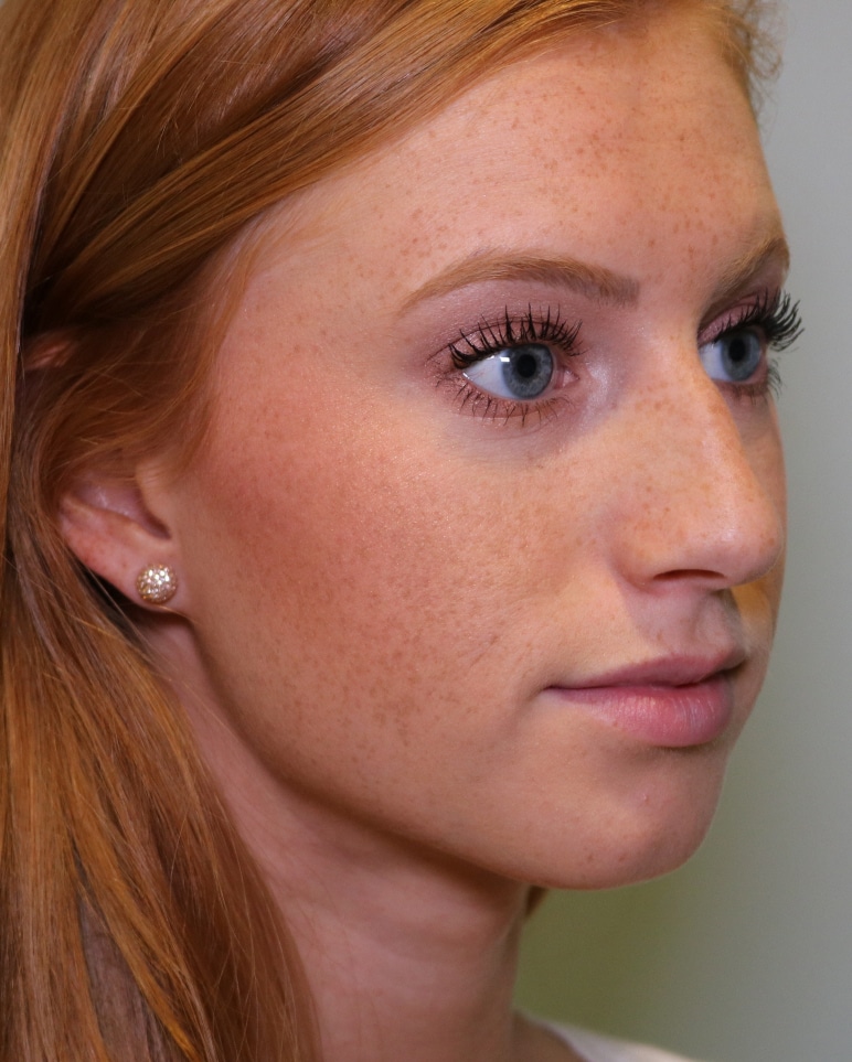 redhead_pre_angle Before boulbous tip rhinoplasty