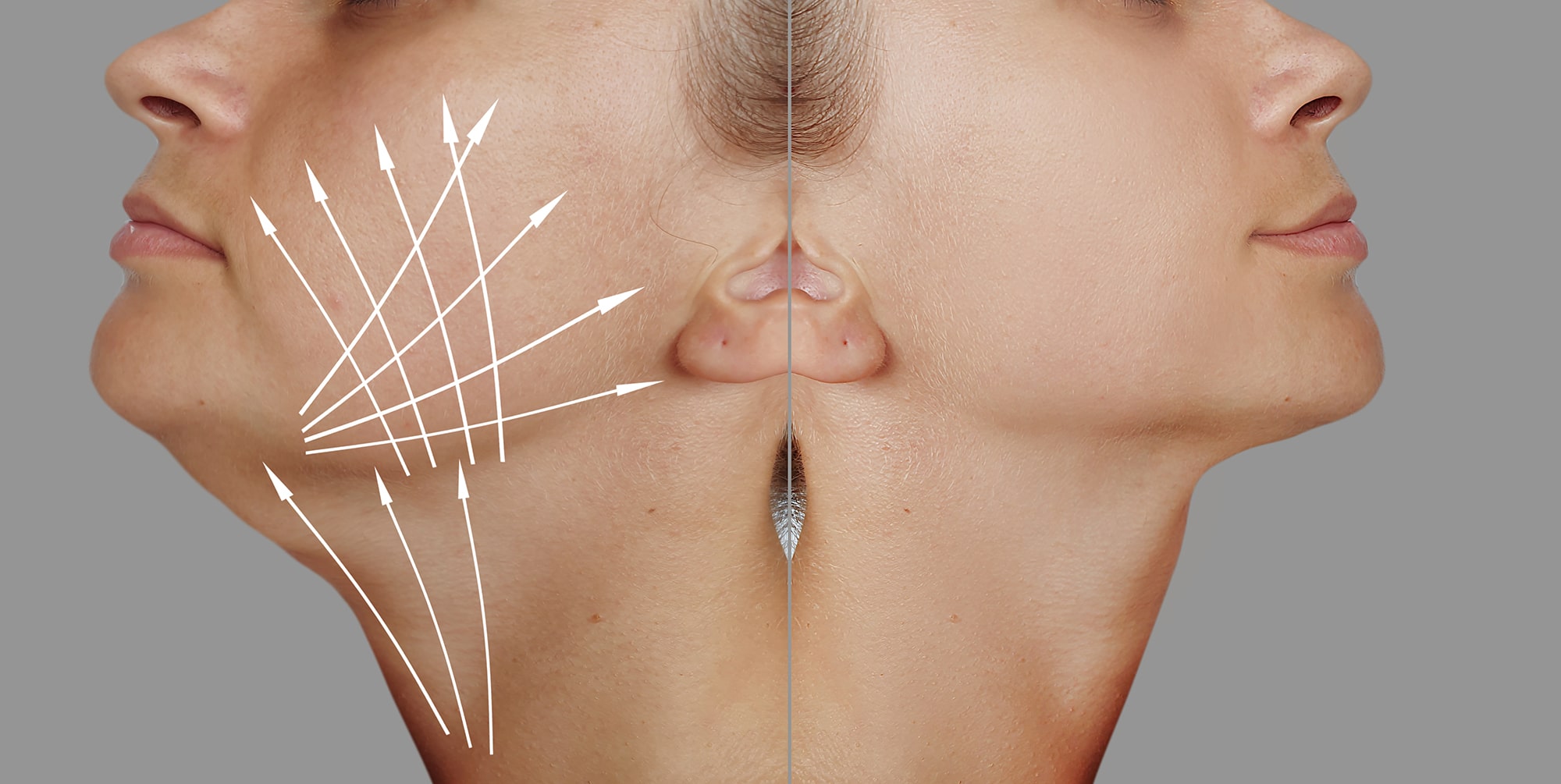 Deep Plane Facelipt