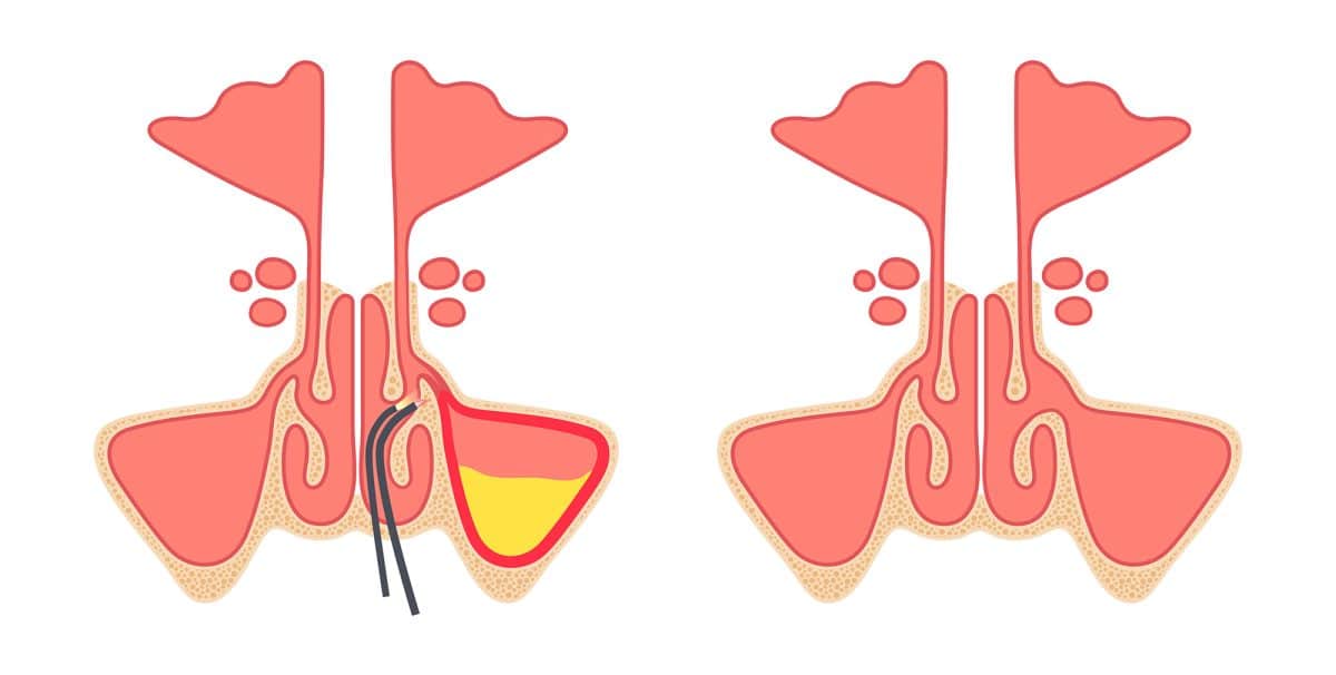 Functional Endoscopic Sinus Surgery Functional Rhinoplasty