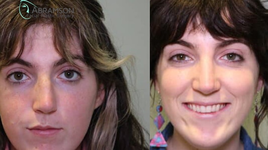 Dorsal Hump (Roman Nose Correction)