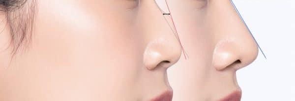 Roman nose with hump Dorsal Hump Rhinoplasty Recovery