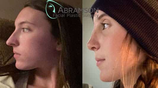 rhinoplasty before and after