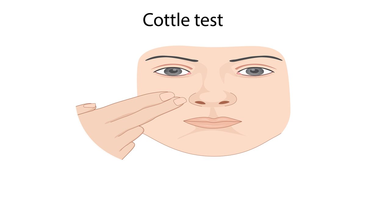 Cottle Maneuver