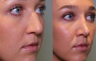 Dorsal Hump Nose Before and After