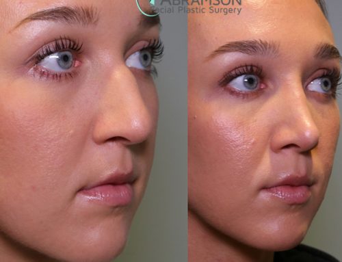 Don’t Like Your Nose? Rhinoplasty Can Resolve!