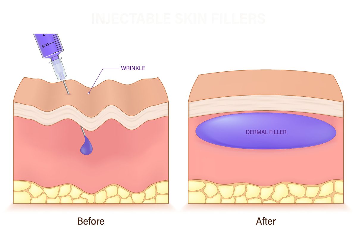 dermal fillers illustration
