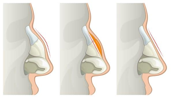 dorsal hump nose rremoval