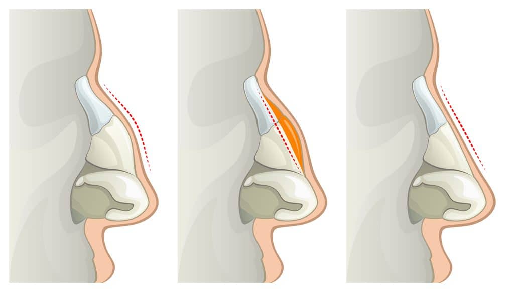 Hump Nose Removal