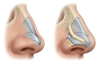 Nasal Valve Collapse