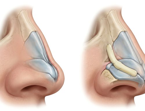 Nasal Valve Collapse