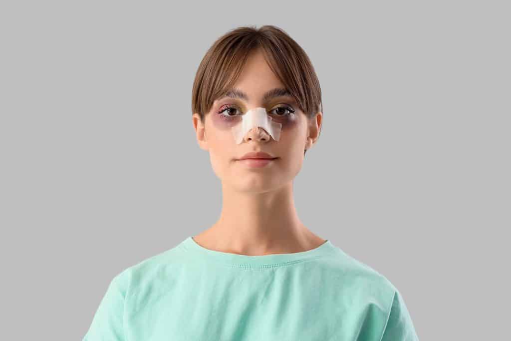 nose splint after rhinoplasty surgery