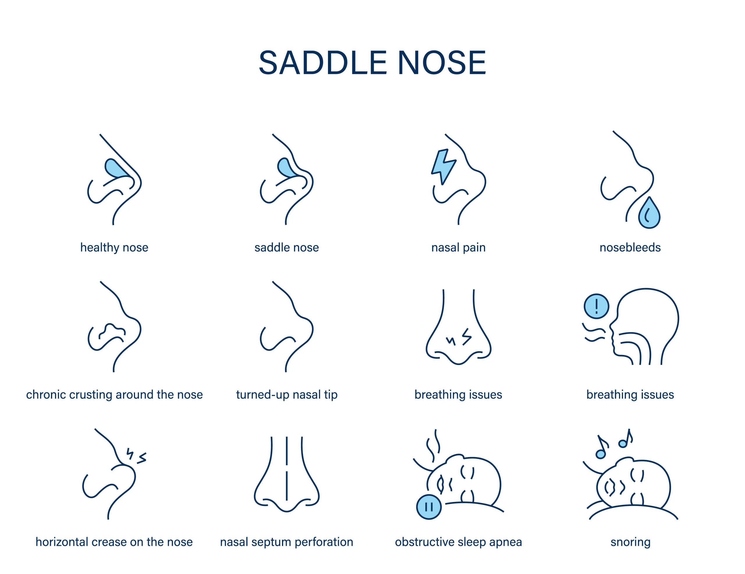 saddle nose rhinoplasty illustration