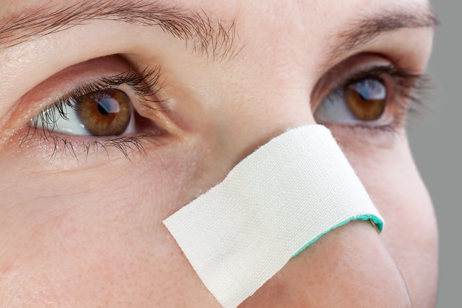 Saddle nose rhinoplasty recovery